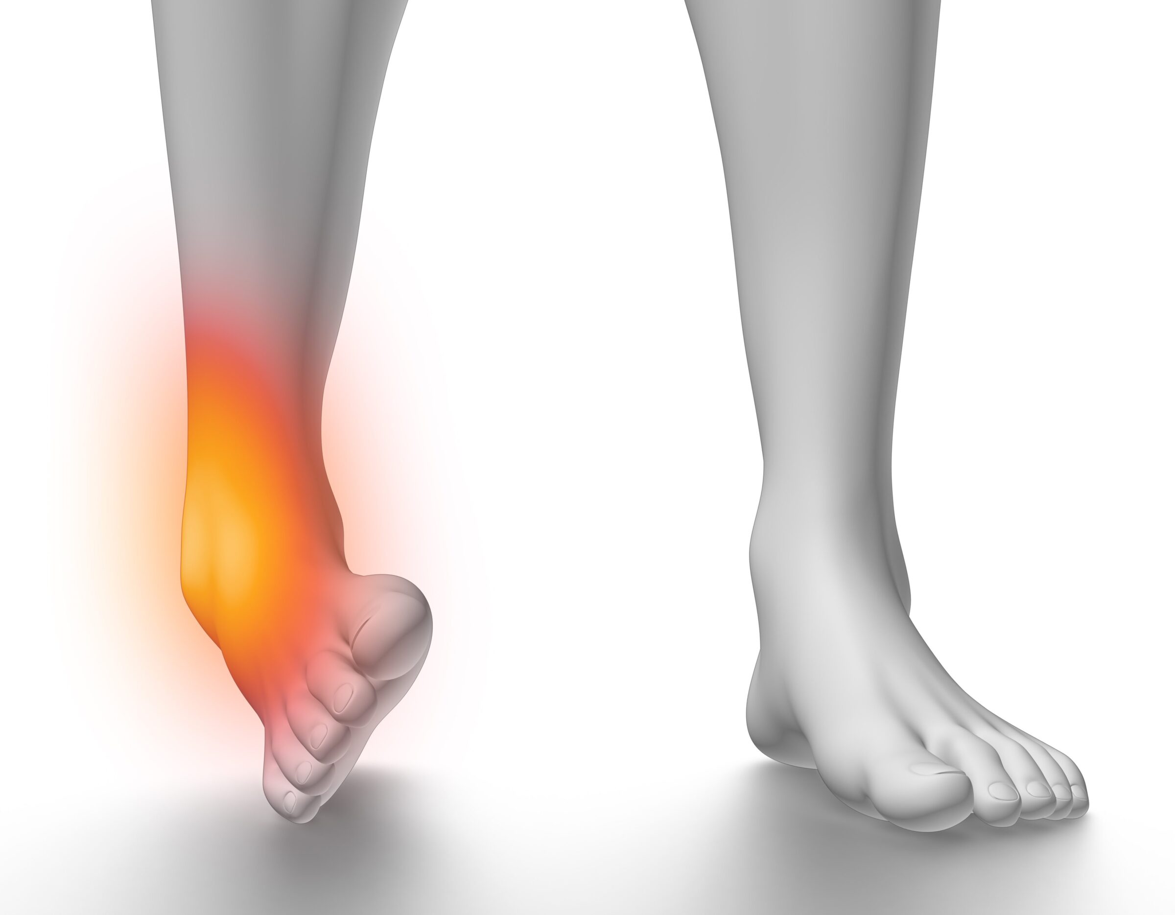 Ankle Sprain illustration